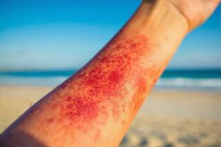 Viszkető, piros kiütések napozás után? Lehet, hogy napallergiád van