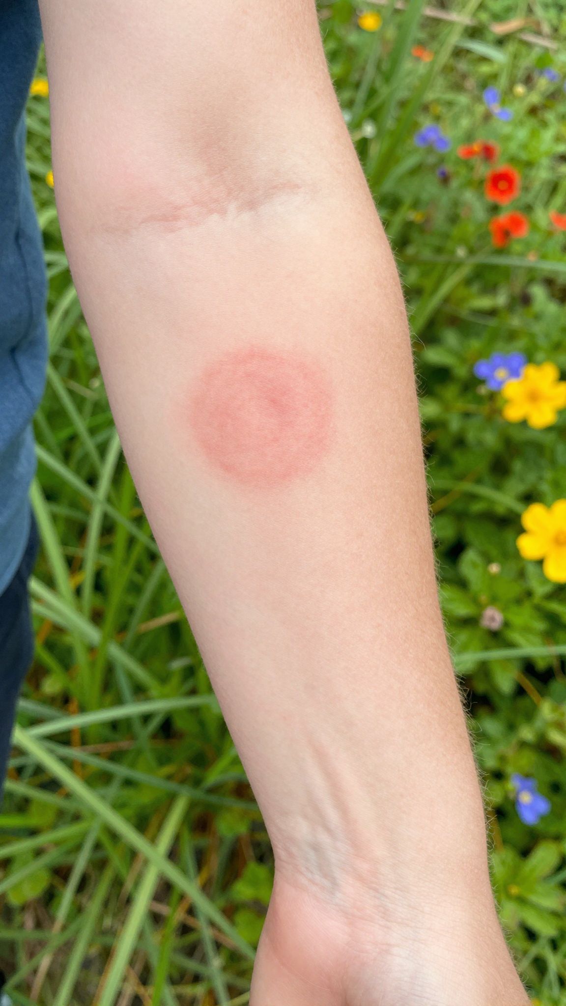 A Lyme-kór korai felismerése fontos a gyógyulás érdekében.