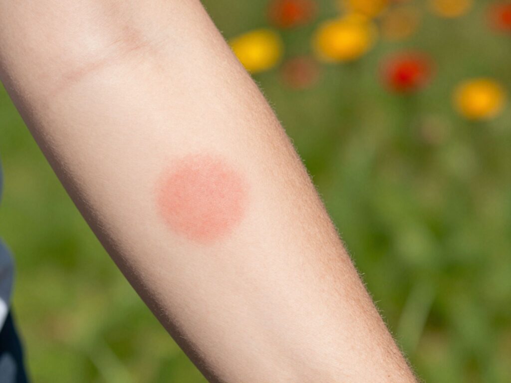 Kokárdaszerű folt a bőrön: a Lyme-kór első jele és a teendők fertőzés gyanúja esetén