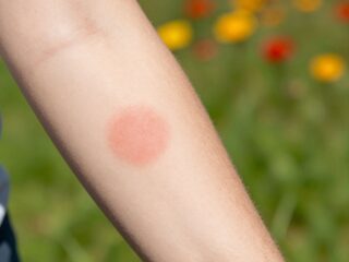 Kokárdaszerű folt a bőrön: a Lyme-kór első jele és a teendők fertőzés gyanúja esetén