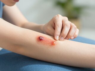 Mire figyelj a császáros seb gyógyulásánál? Intő jelek és teendők