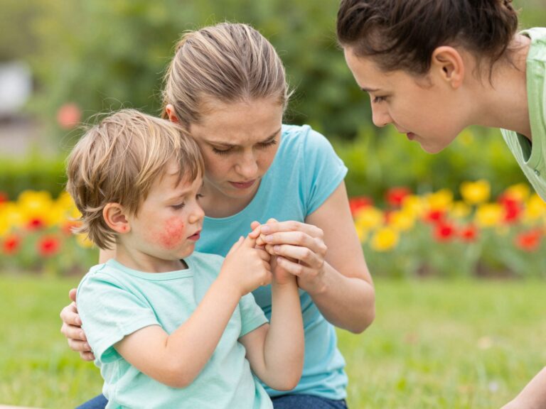 Miért alakul ki az ekcéma? A 7 legfontosabb kiváltó ok, amit minden szülőnek érdemes ismernie