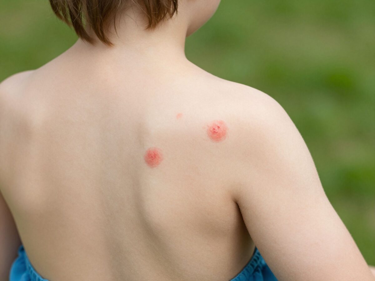 Több, mint csak pöttyök: mi történik a testben bárányhimlő fertőzés alatt?