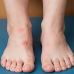 Diszhidrotikus ekcéma: amikor a tenyereden és a talpadon jelennek meg a viszkető hólyagok